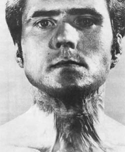 Es ist besonders interessant, dass nachdem über 90% der Haut von Mr. Sanderson verbrannt war, gerade das Gesicht wieder voll hergestellt wurde.