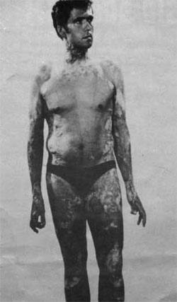 Haut, die sich wieder gebildet hatte, wurde Stück für Stück an die übrigen Körperteile verpflanzt. Die Teile begannen zu wachsen und bedecken heute den Körper von Willie Sanderson.